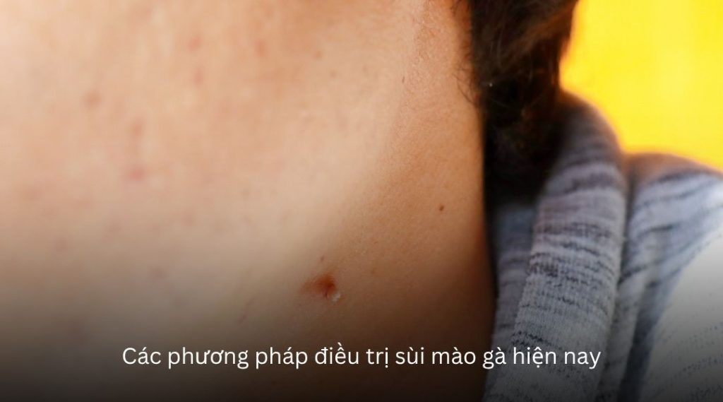 Các phương pháp điều trị sùi mào gà hiện nay