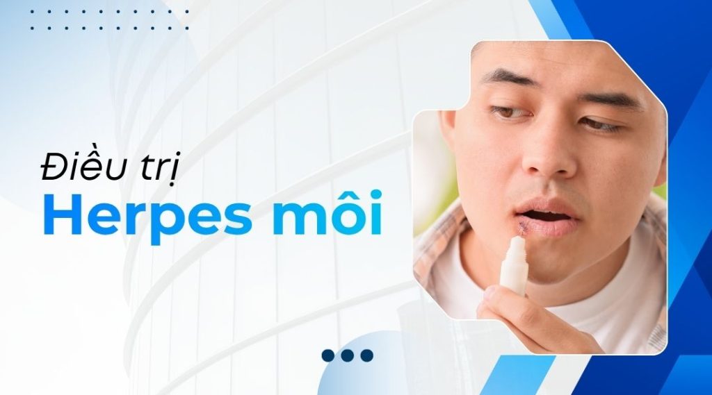 Điều trị herpes môi