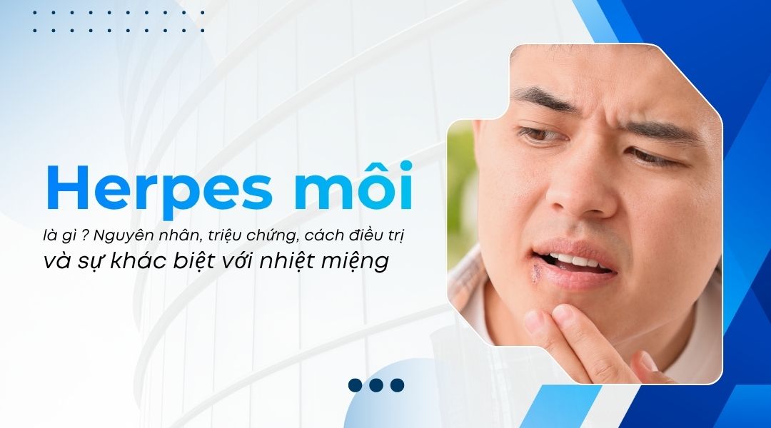 Herpes môi (mụn rộp môi) là gì Nguyên nhân, triệu chứng, cách điều trị và sự khác biệt với nhiệt miệng