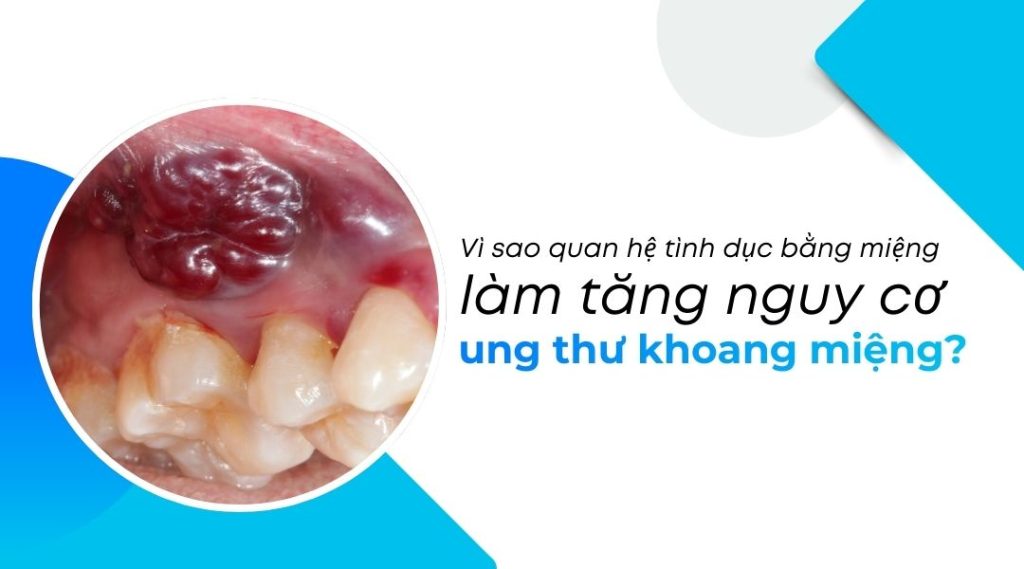 Vì sao quan hệ tình dục bằng miệng làm tăng nguy cơ ung thư khoang miệng